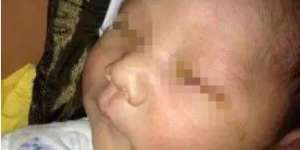 Bayi Buta Permanen Akibat Flash Kamera