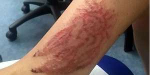 Akibat Henna, Wanita Inggris Alami Kerusakan Kulit