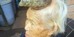 Menyeramkan, di Kepala Nenek Ini Tumbuh Tanduk