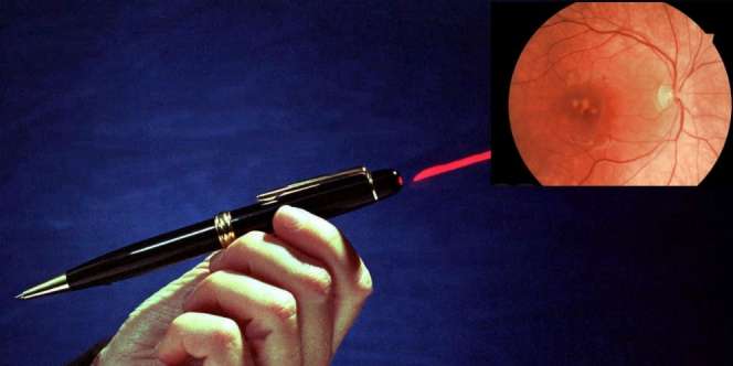 Bocah Ini Buta Gara-gara Bermain Pulpen Laser, Mata Terbakar