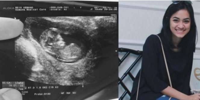 Hamil, Ayudia Bing Slamet Sebut `Si Kacang` untuk Calon Bayi