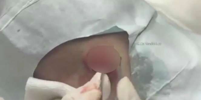 Dokter Bedah Benjolan dan Menemukan Sesuatu Mengejutkan!