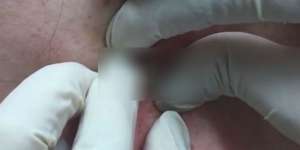 Dokter Kaget, Bedah Benjolan di Punggung Isinya...