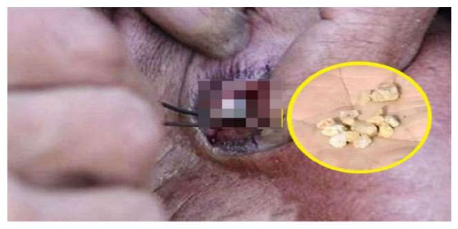 Dokter Bingung, Mata Wanita Ini Keluarkan Batu Kerikil