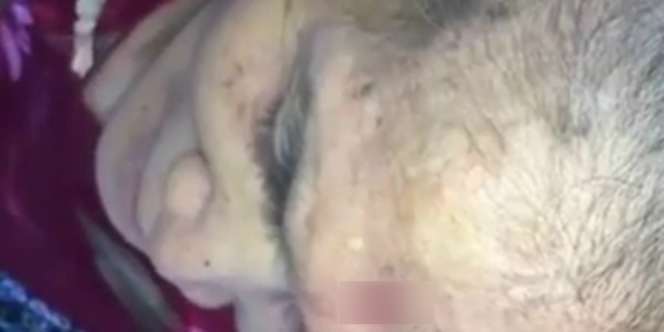 Seram! Ini Proses Pengeluaran Susuk dari Wajah Wanita