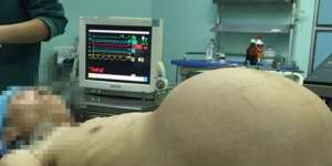 Pria Ini Seperti Hamil, Dokter Temukan Benda Mengejutkan