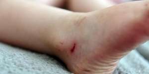 Menyedihkan, Kaki Balita Ini Berdarah Pakai Sandal Jelly