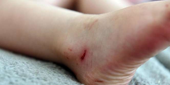 Menyedihkan, Kaki Balita Ini Berdarah Pakai Sandal Jelly