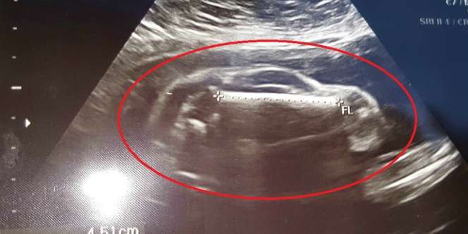 Mengejutkan, Janin Berbentuk Mobil Sport