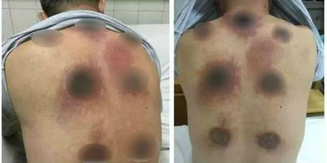 Pria Ini Bekam Punggung Selama Sebulan, Akibatnya....