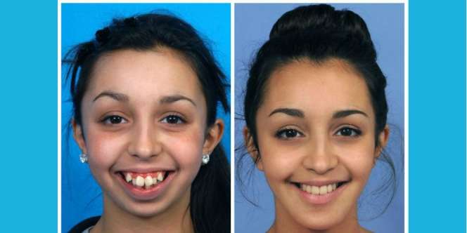 Foto 'Before-After' Gadis Ini Cengangkan Dunia