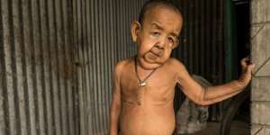 Usia Baru 4 Tahun, Fisik Seperti Kakek 80 Tahun