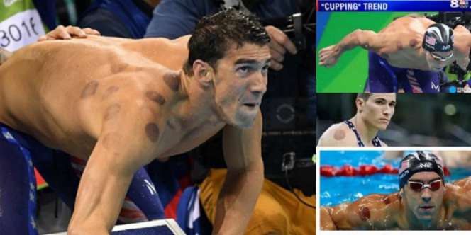 Masyaallah! Teknik Pengobatan Nabi Ditiru Atlet Olimpiade 2016