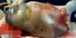 Langka, Bayi Lahir Masih di Dalam Ketuban
