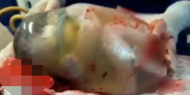 Langka, Bayi Lahir Masih di Dalam Ketuban