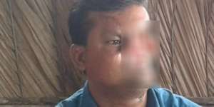Separuh Wajah Pria Ini Hilang Diterkam Harimau