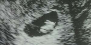 Kocak! Foto Janin Ini Mirip dengan Kelinci