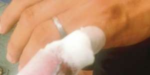Suami Pulang Terlambat, Jari Kelingking Putus Digigit Istri