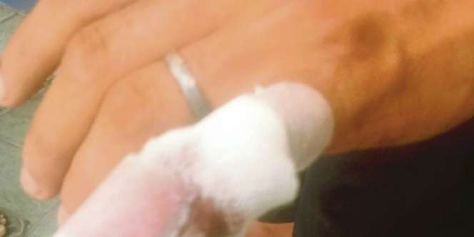Suami Pulang Terlambat, Jari Kelingking Putus Digigit Istri