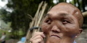 Akibat Penyakit Langka, Pria Ini Berwajah `Kotak` 