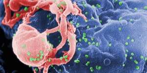 Ilmuwan Sudah Temukan Obat HIV/AIDS?