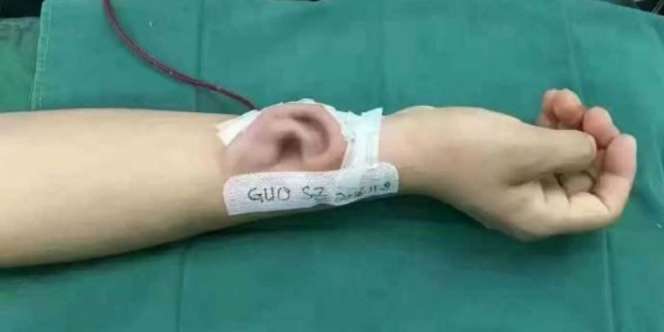 Pria Ini Punya Daun Telinga di Tangan