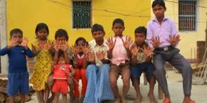Satu Keluarga di India Punya 12 Jari Tangan dan 12 Jari Kaki