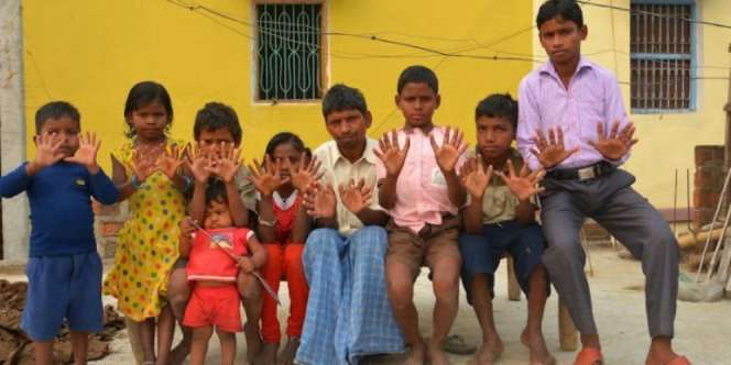 Satu Keluarga di India Punya 12 Jari Tangan dan 12 Jari Kaki