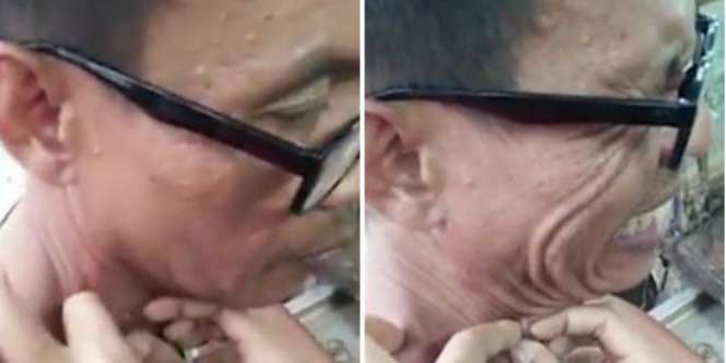 Komedo Besar Selama 20 Tahun Itu Akhirnya Tercabut, Isinya...