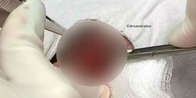 Benjolan di Sudut Mata, Saat Dibedah Isinya...