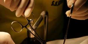 Cerita Sunat Laser Berujung Petaka