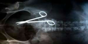 Heboh Gunting Bedah Tertinggal dalam Usus Selama 18 Tahun