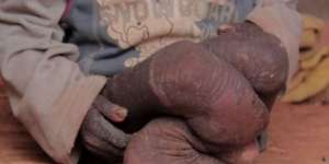 Kulit Anak Ini Perlahan Membatu Seperti Kisah Malin Kundang