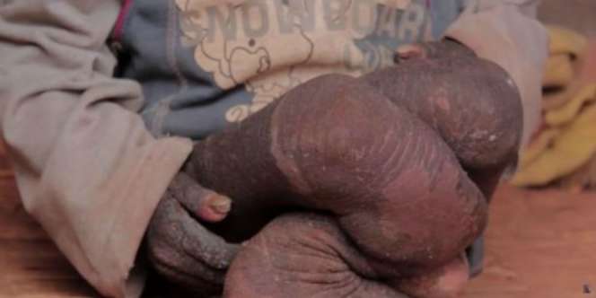 Kulit Anak Ini Perlahan Membatu Seperti Kisah Malin Kundang