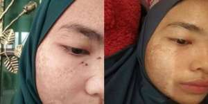 Alih-alih Cantik, Kulit Si Cewek Malah Bersisik Seperti Ular