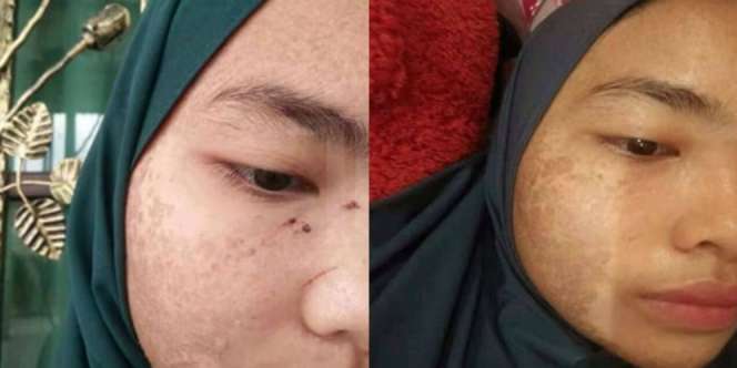 Alih-alih Cantik, Kulit Si Cewek Malah Bersisik Seperti Ular