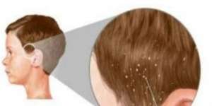 Jarang Diketahui! Ini Cara Efektif Berantas Kutu Rambut 