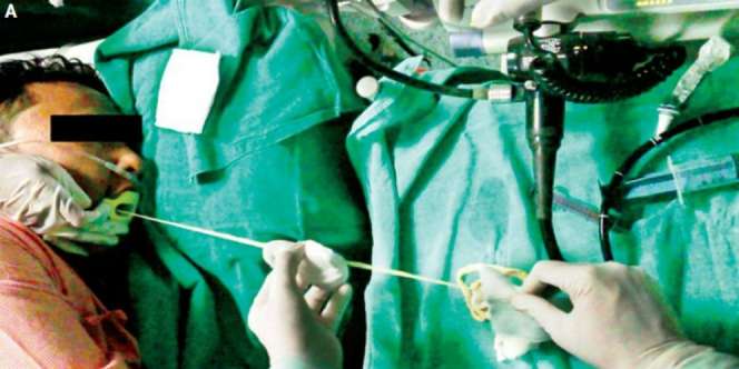 Perut Sering Sakit, Dokter Kaget Lihat yang Keluar dari Mulut