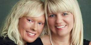 Dulu Diejek, Kini Wanita 'Bersisik' Itu Jadi Ratu Kecantikan