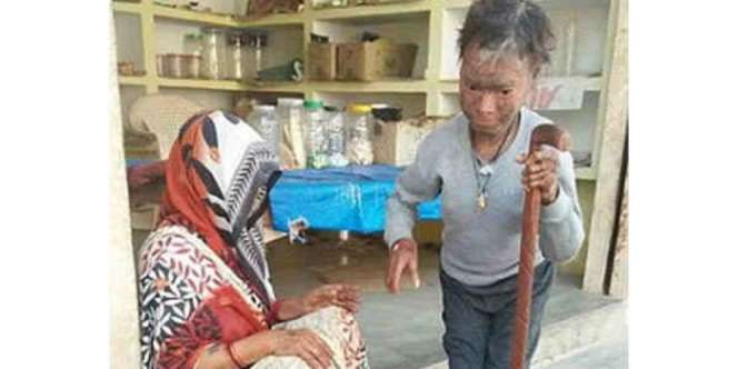 Alami Sakit Langka, Kulit Gadis Mengelupas Tiap 6 Minggu