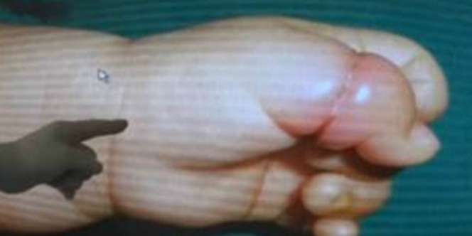 Tangan Bayi Hampir Putus Gara-gara Sehelai Rambut