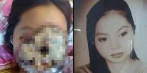 Tragis! Remehkan Infeksi Sinus, Muka Calon Artis Ini Hancur