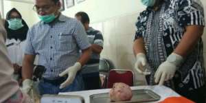 Hamil 37 Tahun, Wanita di Jambi Lahirkan Bayi Sudah Membatu