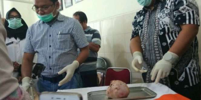 Hamil 37 Tahun, Wanita di Jambi Lahirkan Bayi Sudah Membatu