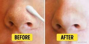 9 Cara Alami Singkirkan Komedo di Wajah dan Hidung