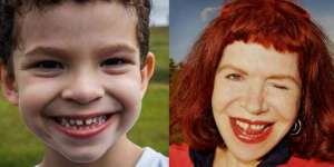 Orang Bergigi Renggang Punya Banyak Keberuntungan?