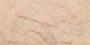 Perubahan Kulit Pada Trimester 3 Kehamilan