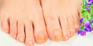 Warna Kuku Kaki Menghitam, Hati-hati! 6 Penyakit Ini Mengintai