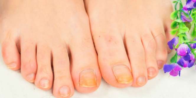 Warna Kuku Kaki Menghitam, Hati-hati! 6 Penyakit Ini Mengintai