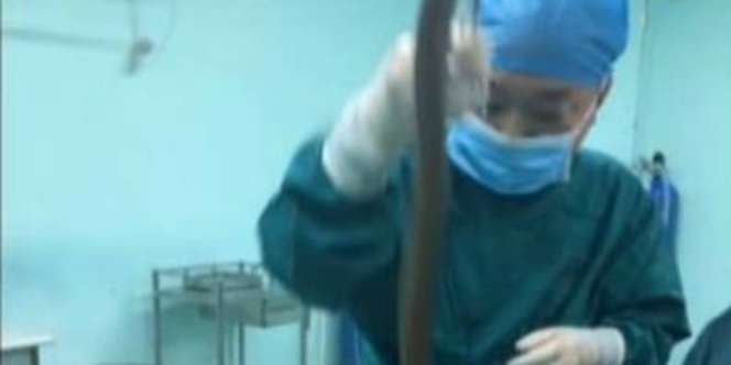 Dokter Terkejut Belut Raksasa Hidup di Tubuh Pria, Ditelisik..